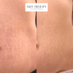 Sposoby na redukcji rozstępów