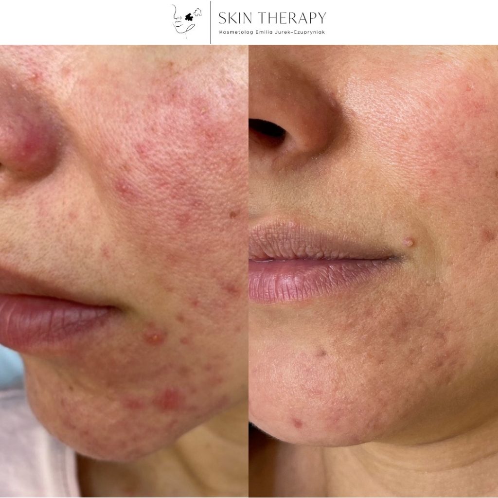 terapie skóry – 84