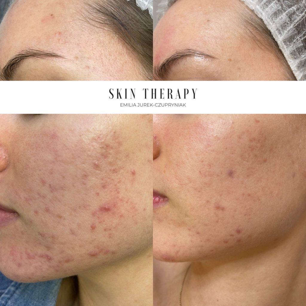 terapie skóry – 75