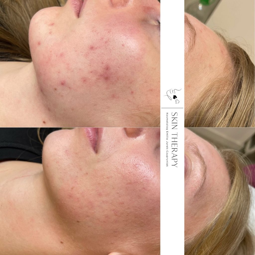 terapie skóry – 81