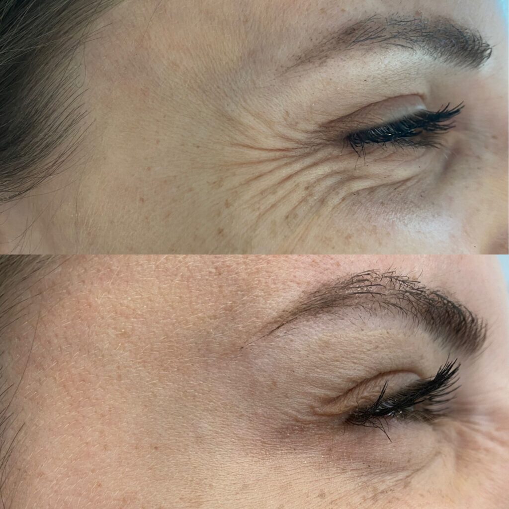 toksyna botulinowa – 8