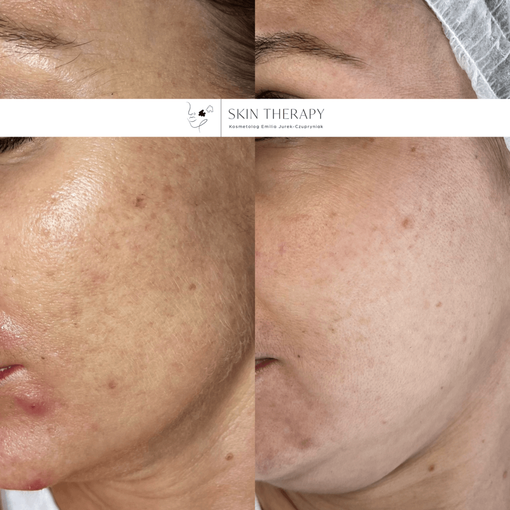 terapie skóry – 14