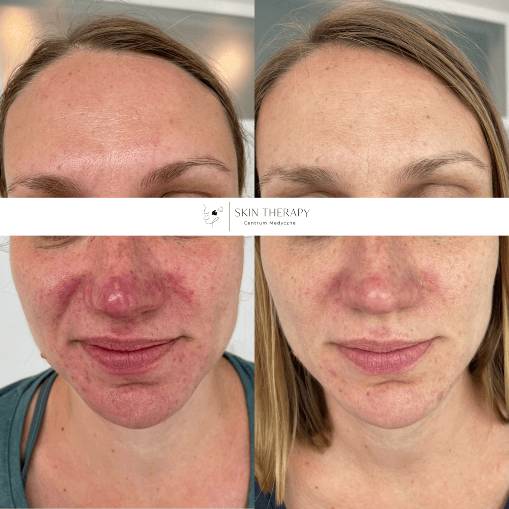 terapie skóry – 13