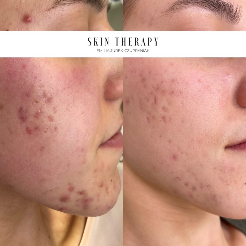 terapie skóry – 73