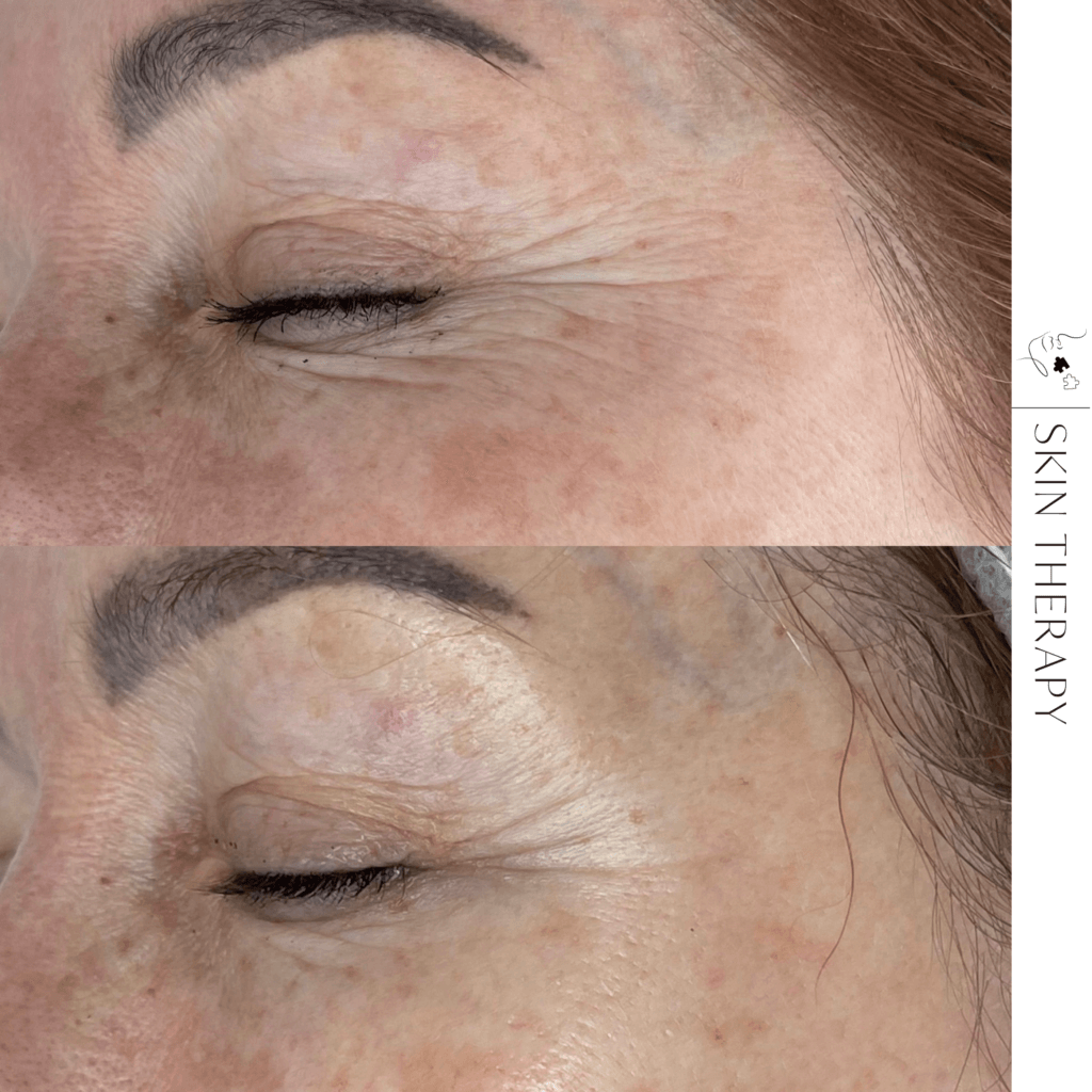 terapie skóry – 16