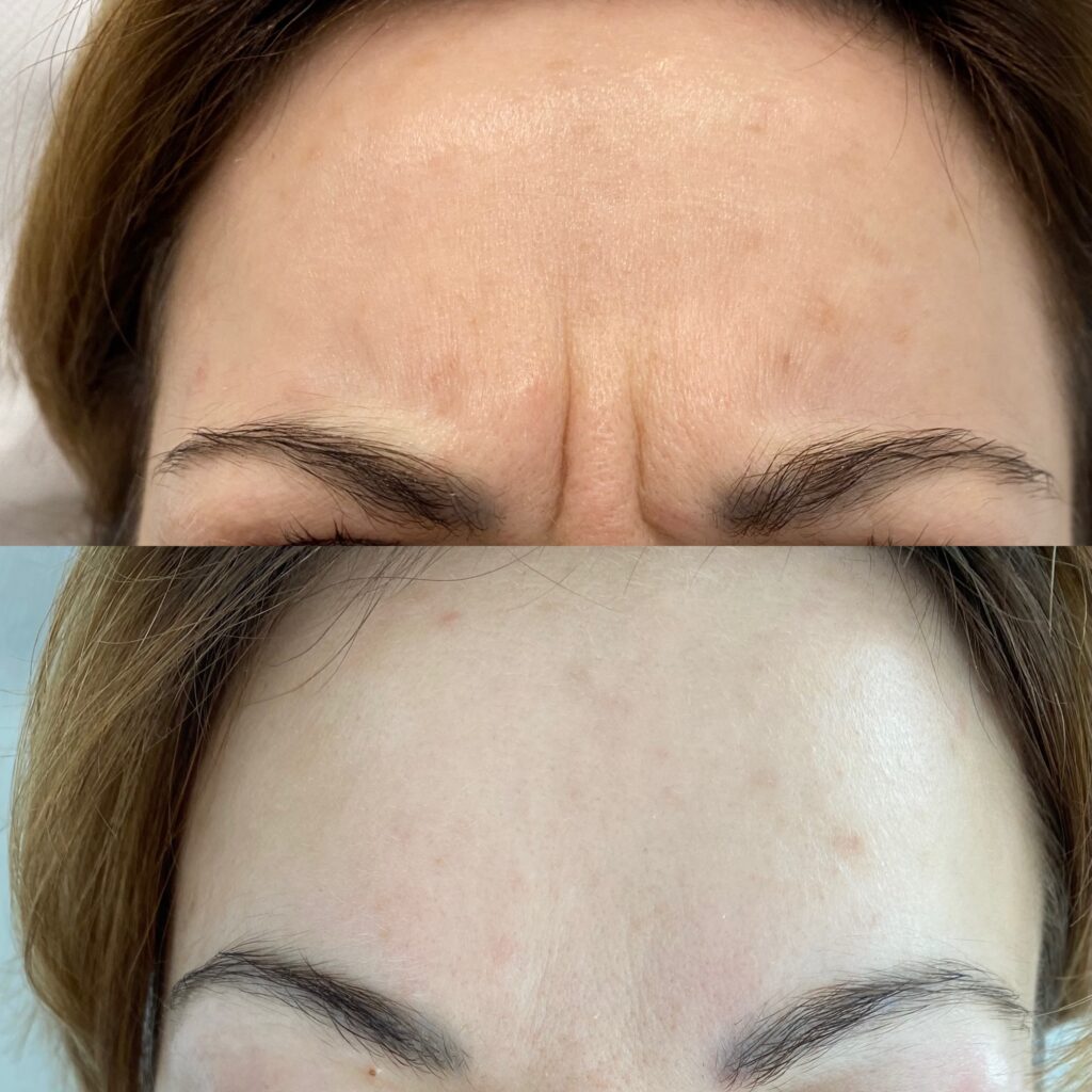 toksyna botulinowa – 12