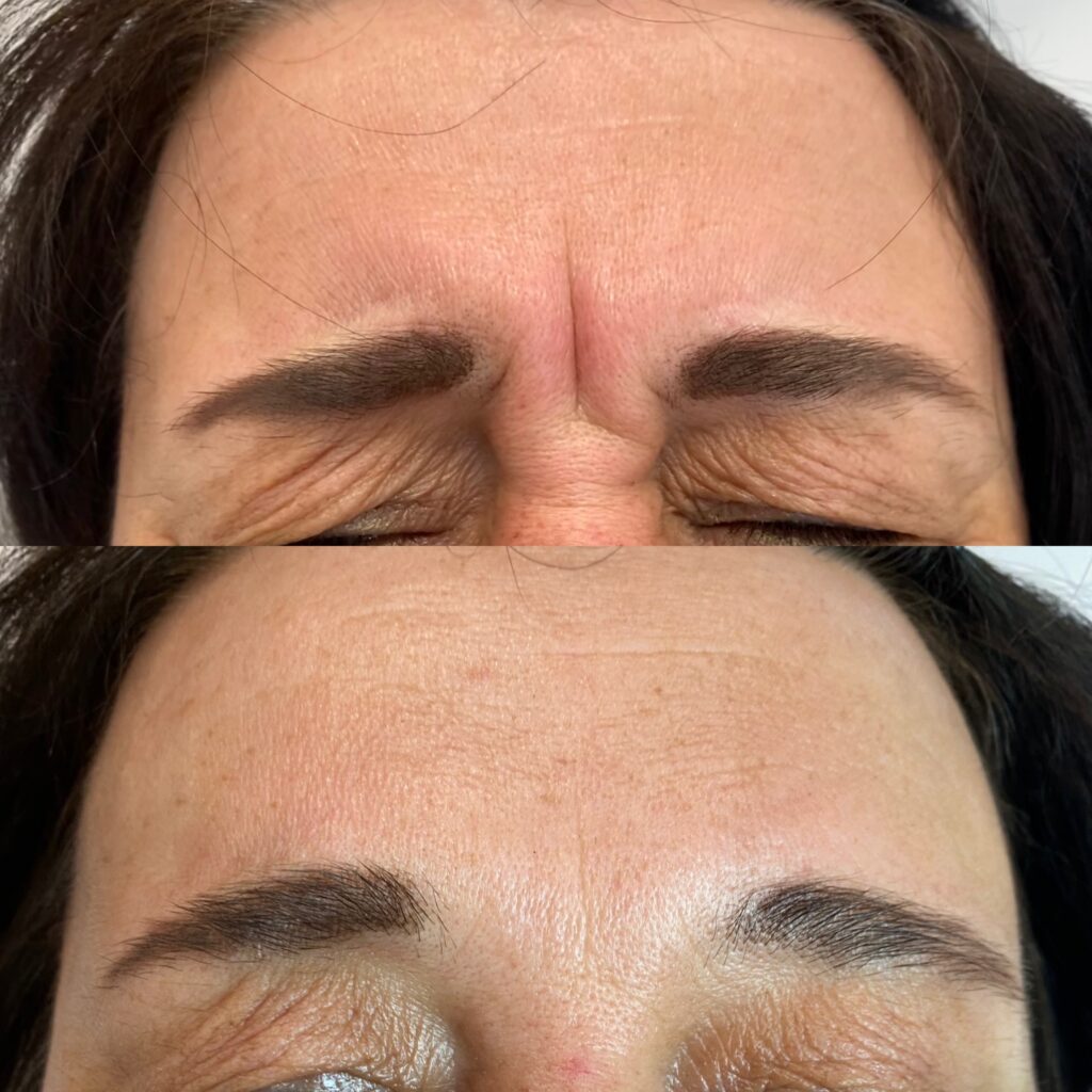 toksyna botulinowa – 11