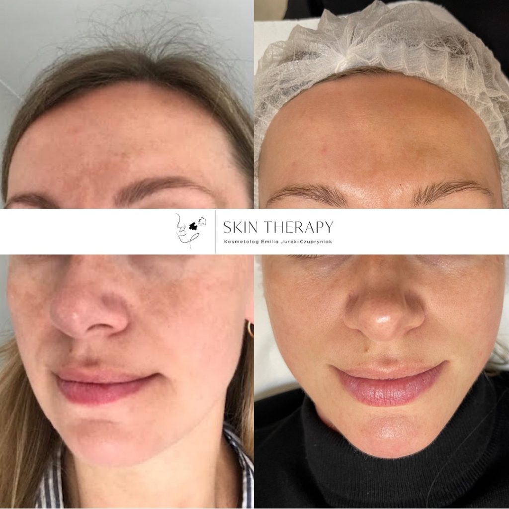 terapie skóry – 71