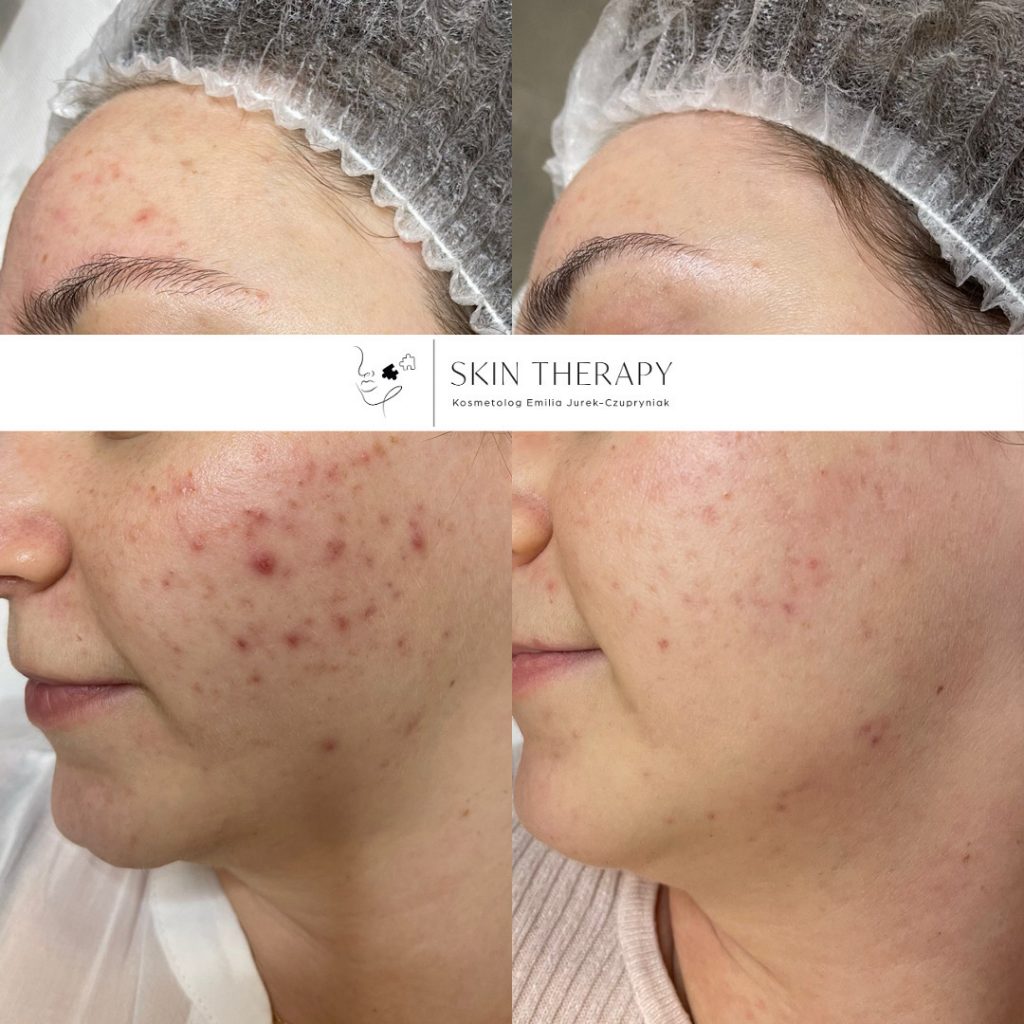 terapie skóry – 80