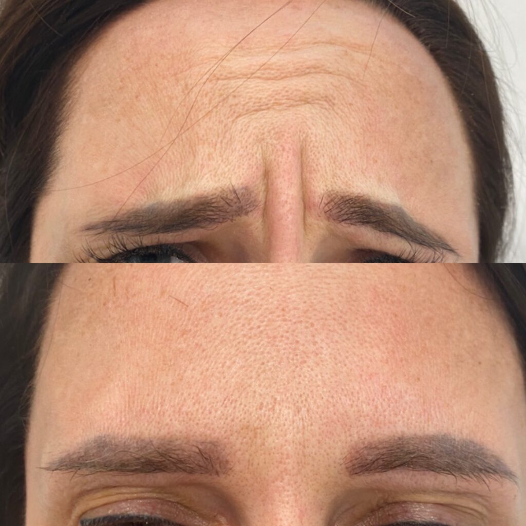 toksyna botulinowa – 10