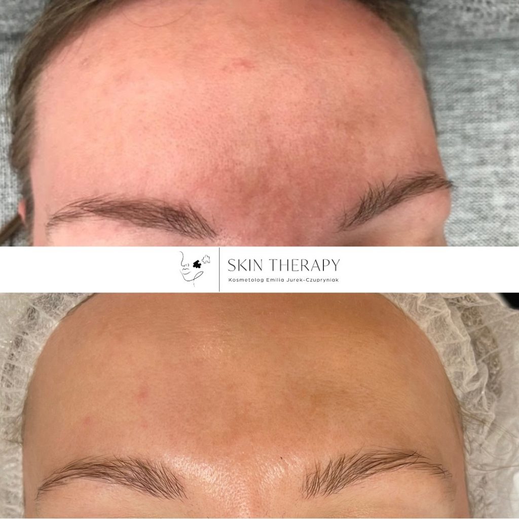 terapie skóry – 82