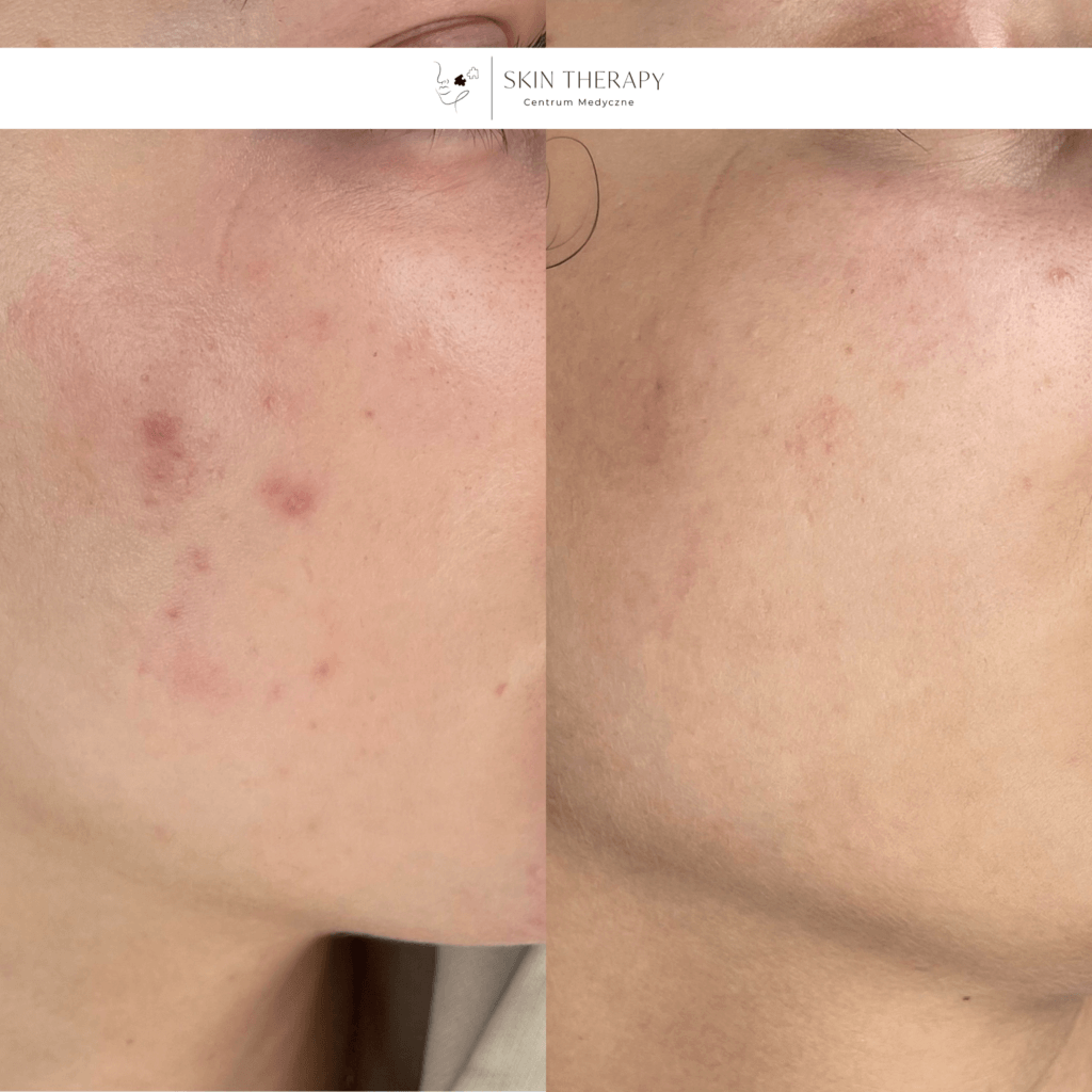 terapie skóry – 35