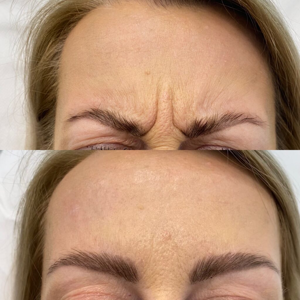 toksyna botulinowa – 7