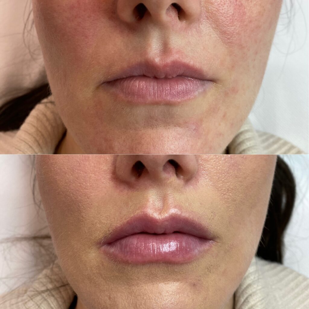 powiększanie ust – 9