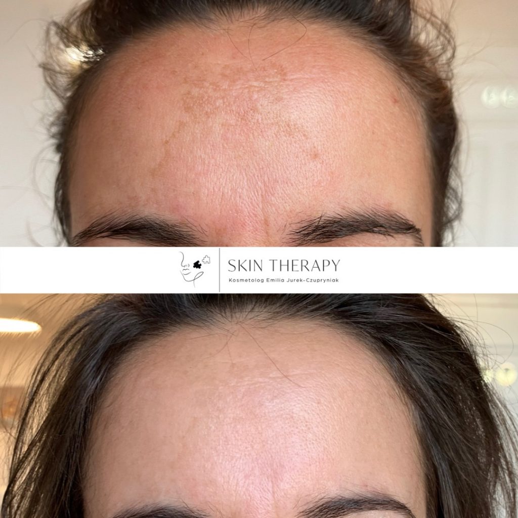 terapie skóry – 78