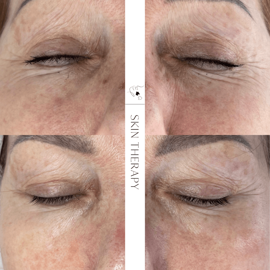 terapie skóry – 15