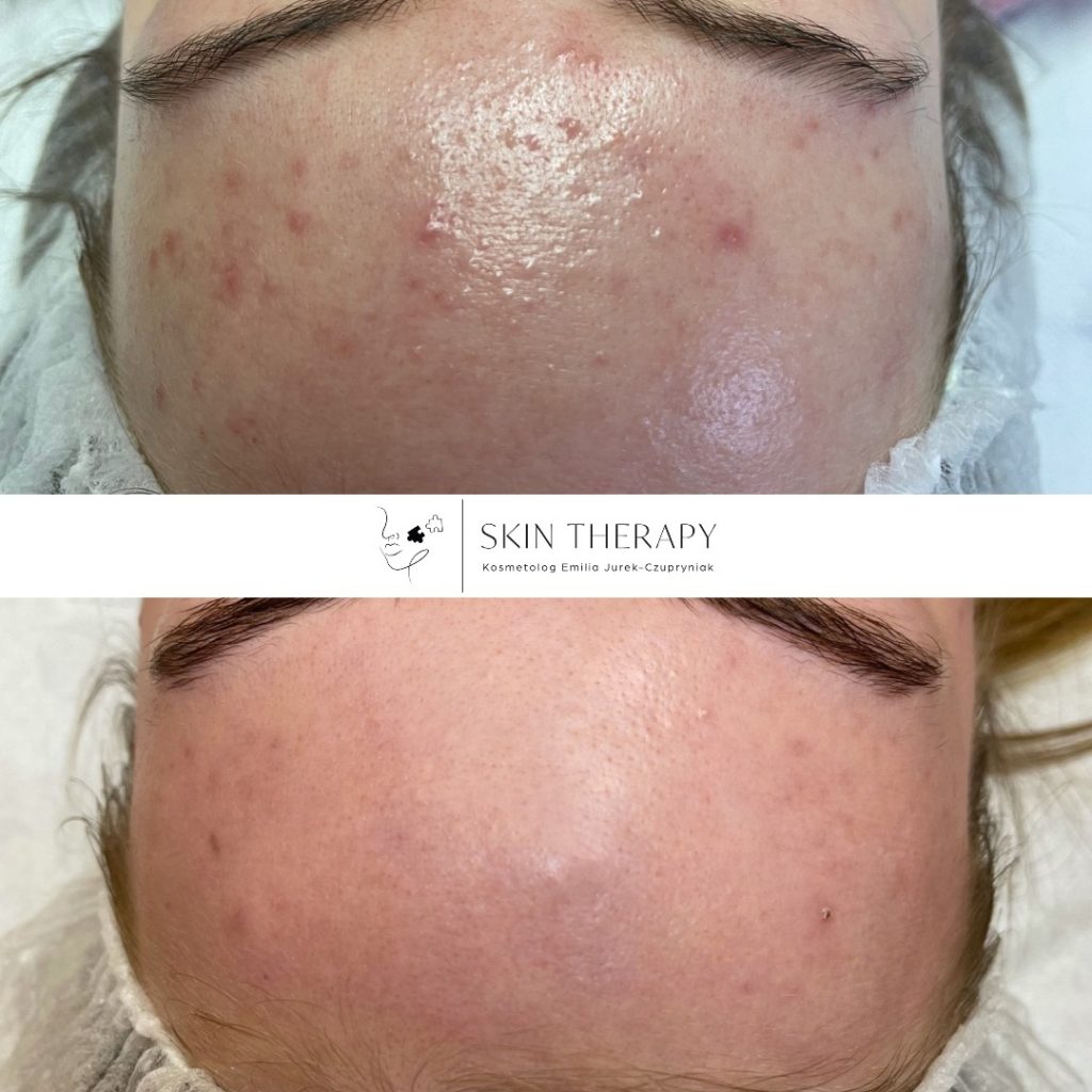 terapie skóry – 77