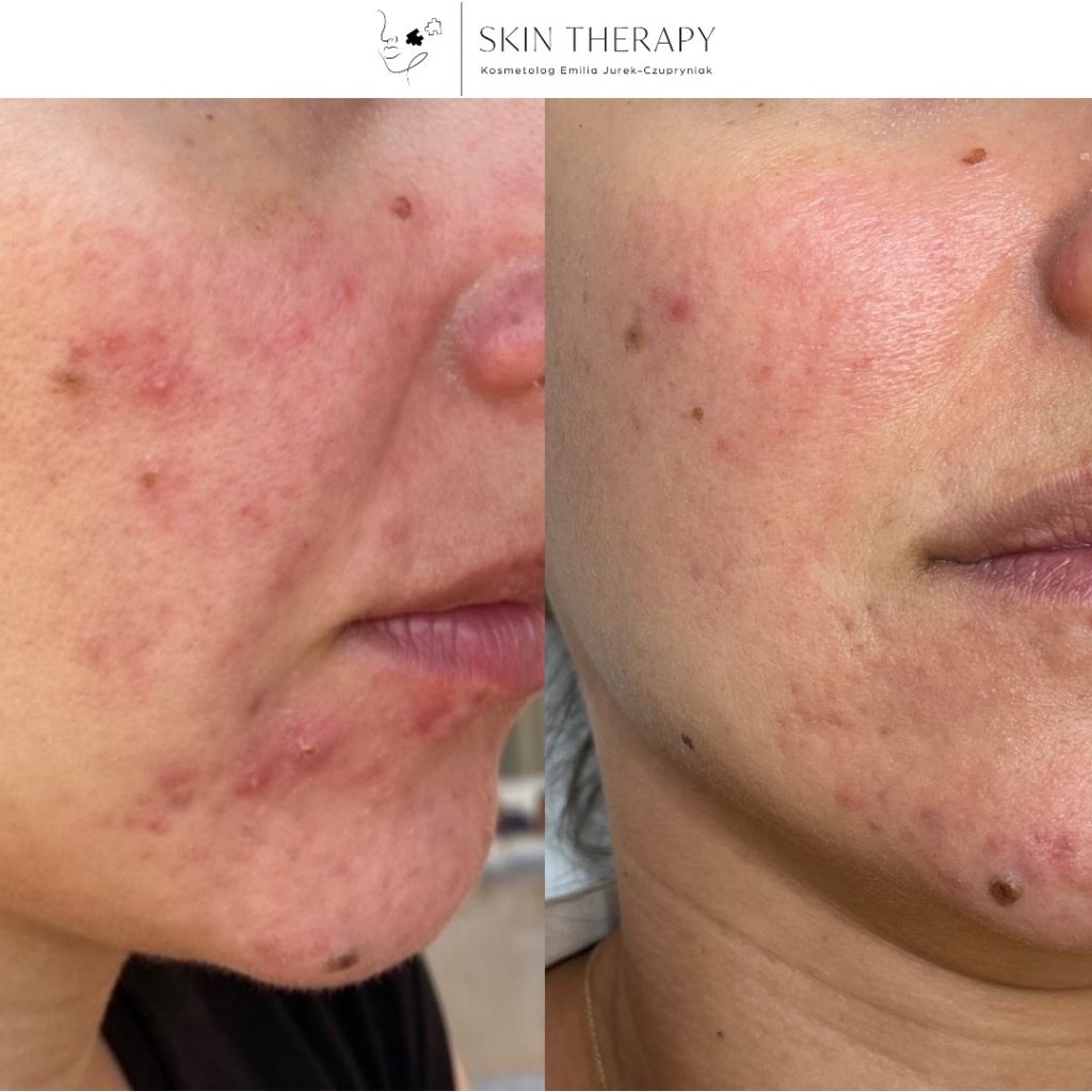 terapie skóry – 76