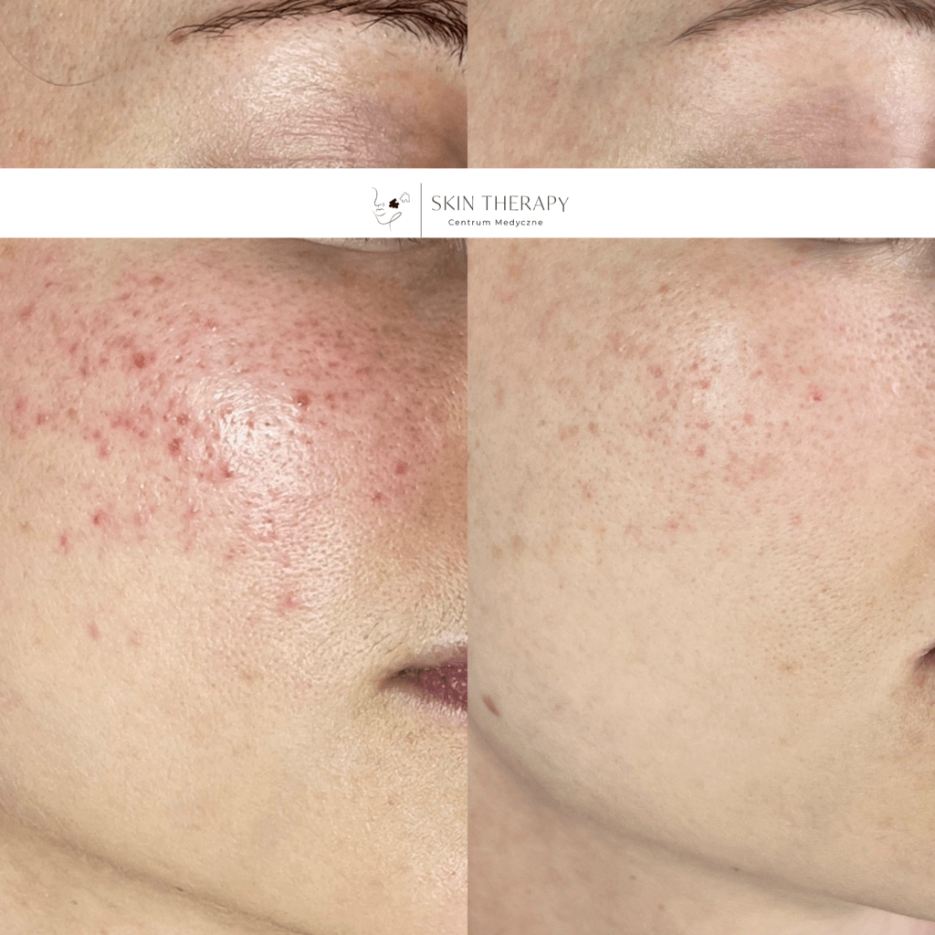 terapie skóry – 17