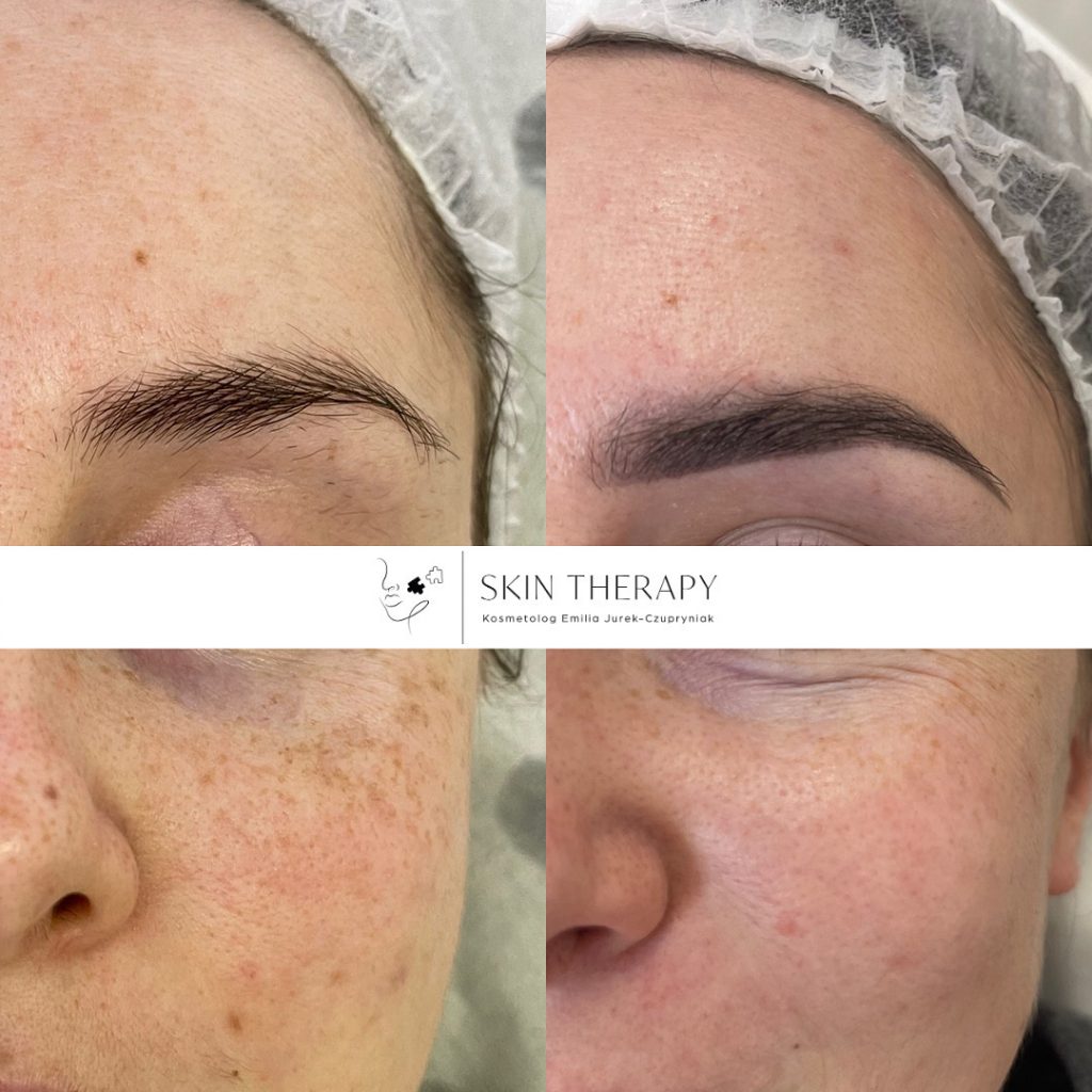 terapie skóry – 74
