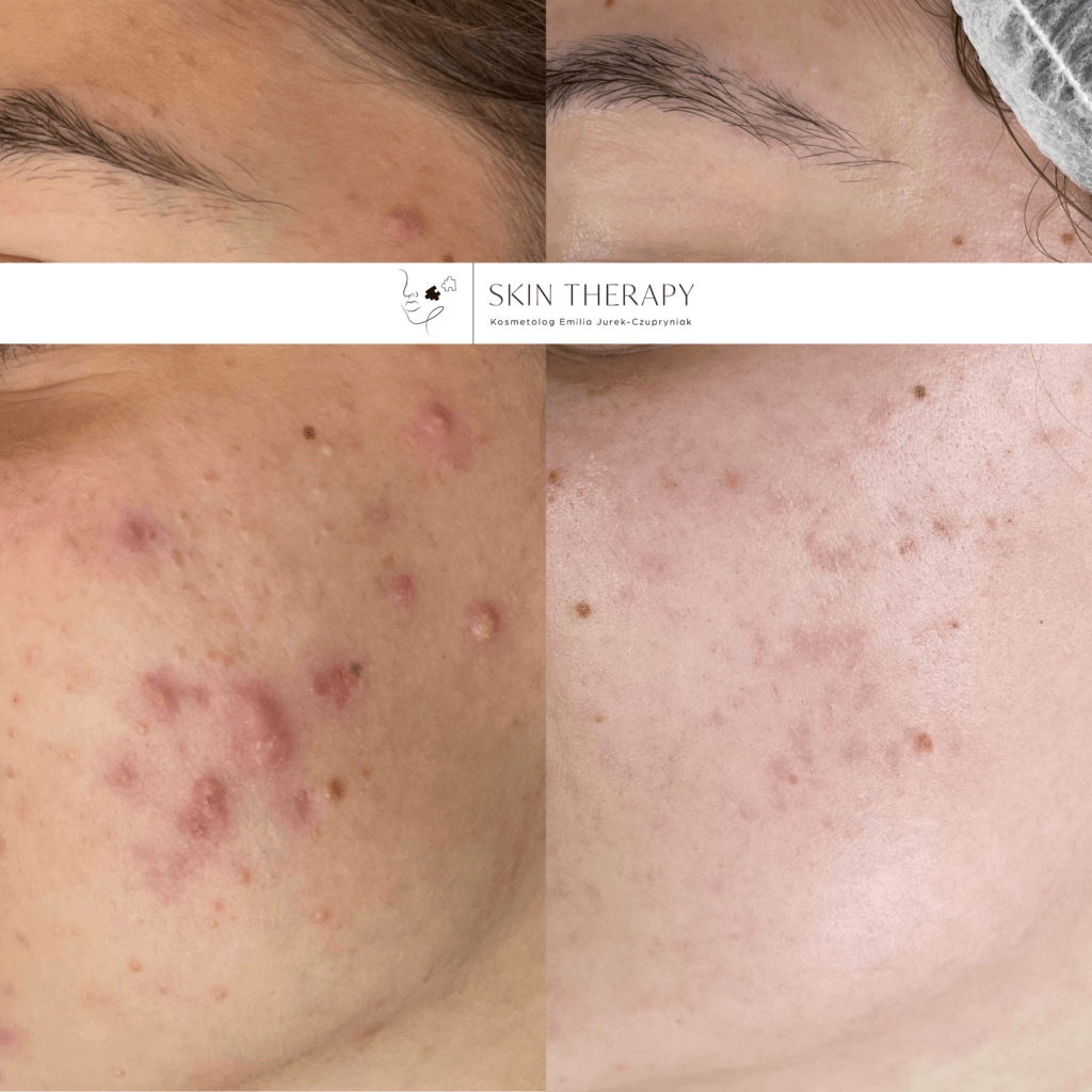 terapie skóry – 34