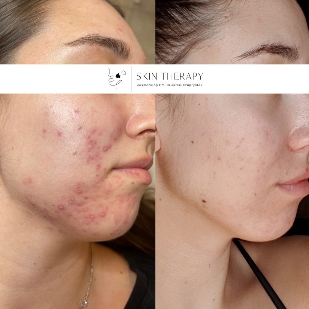 terapie skóry – 69