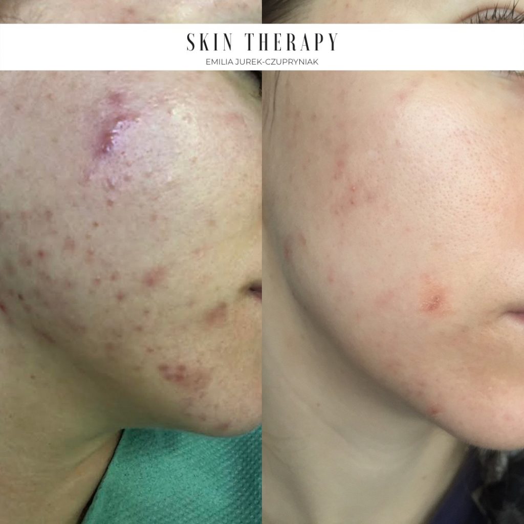 terapie skóry – 68