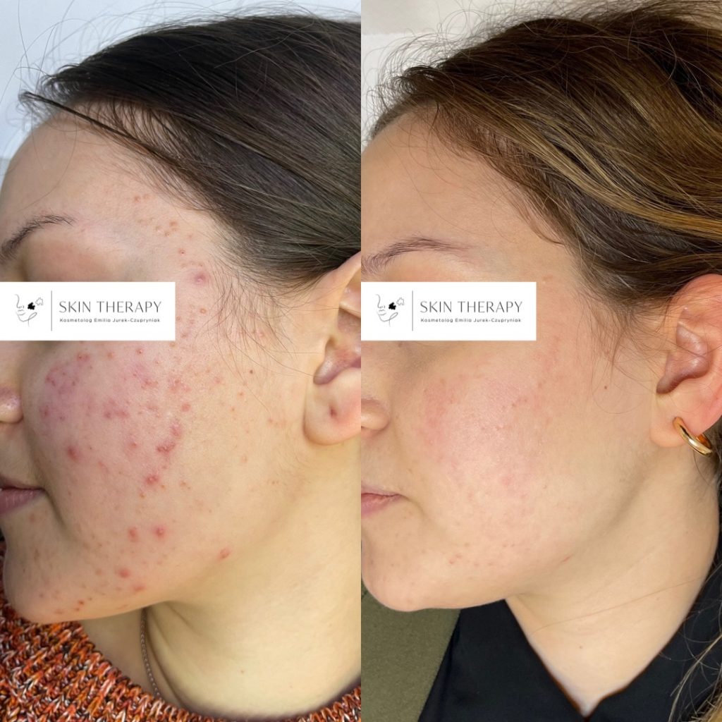 terapie skóry – 67