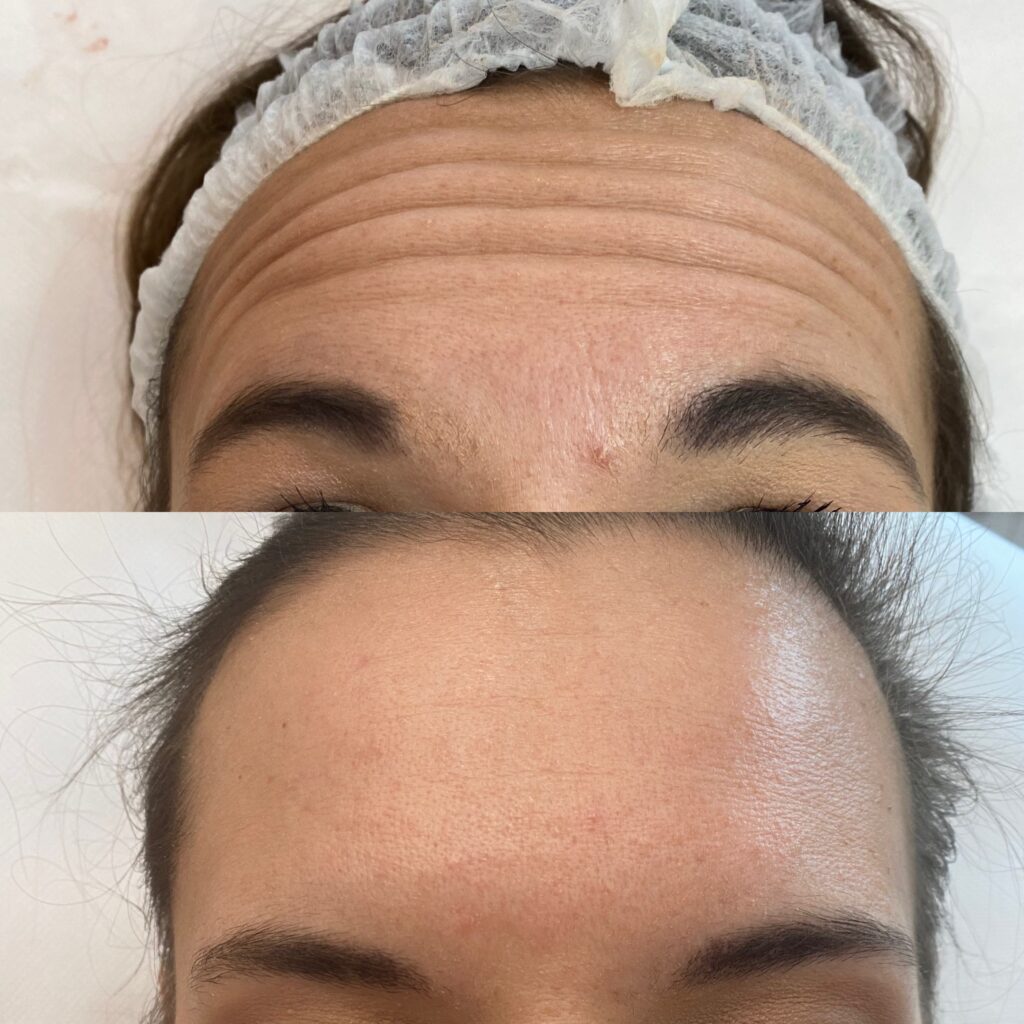 toksyna botulinowa – 3