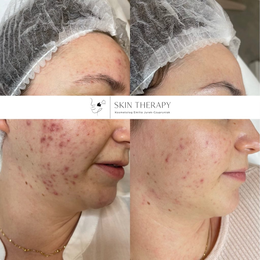 terapie skóry – 65
