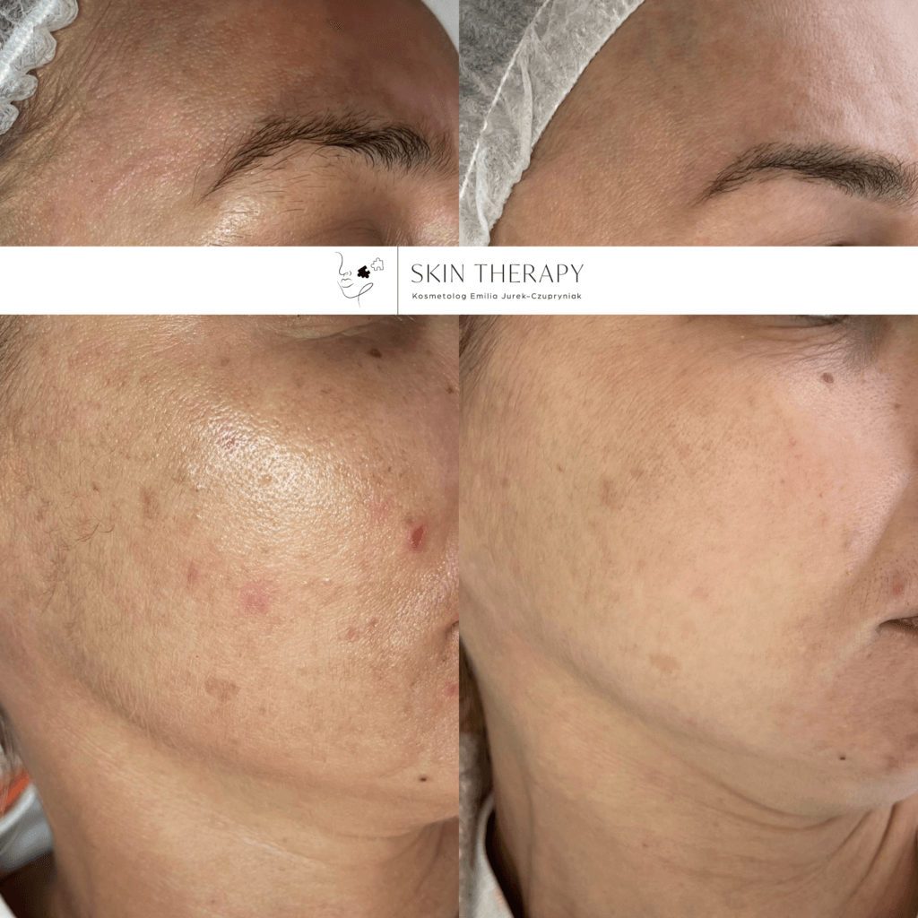 terapie skóry – 12