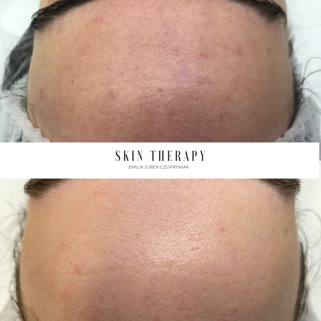 terapie skóry – 64