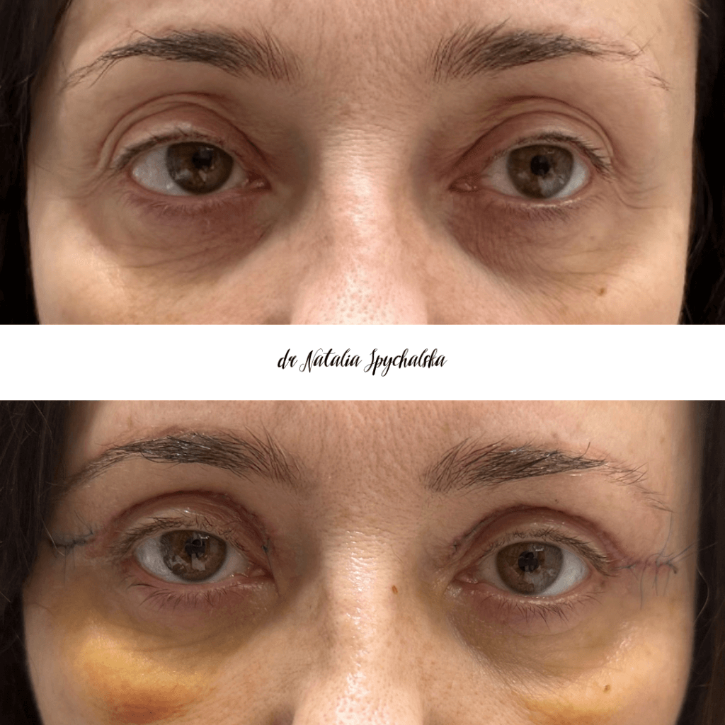 blefaroplastyka – 8