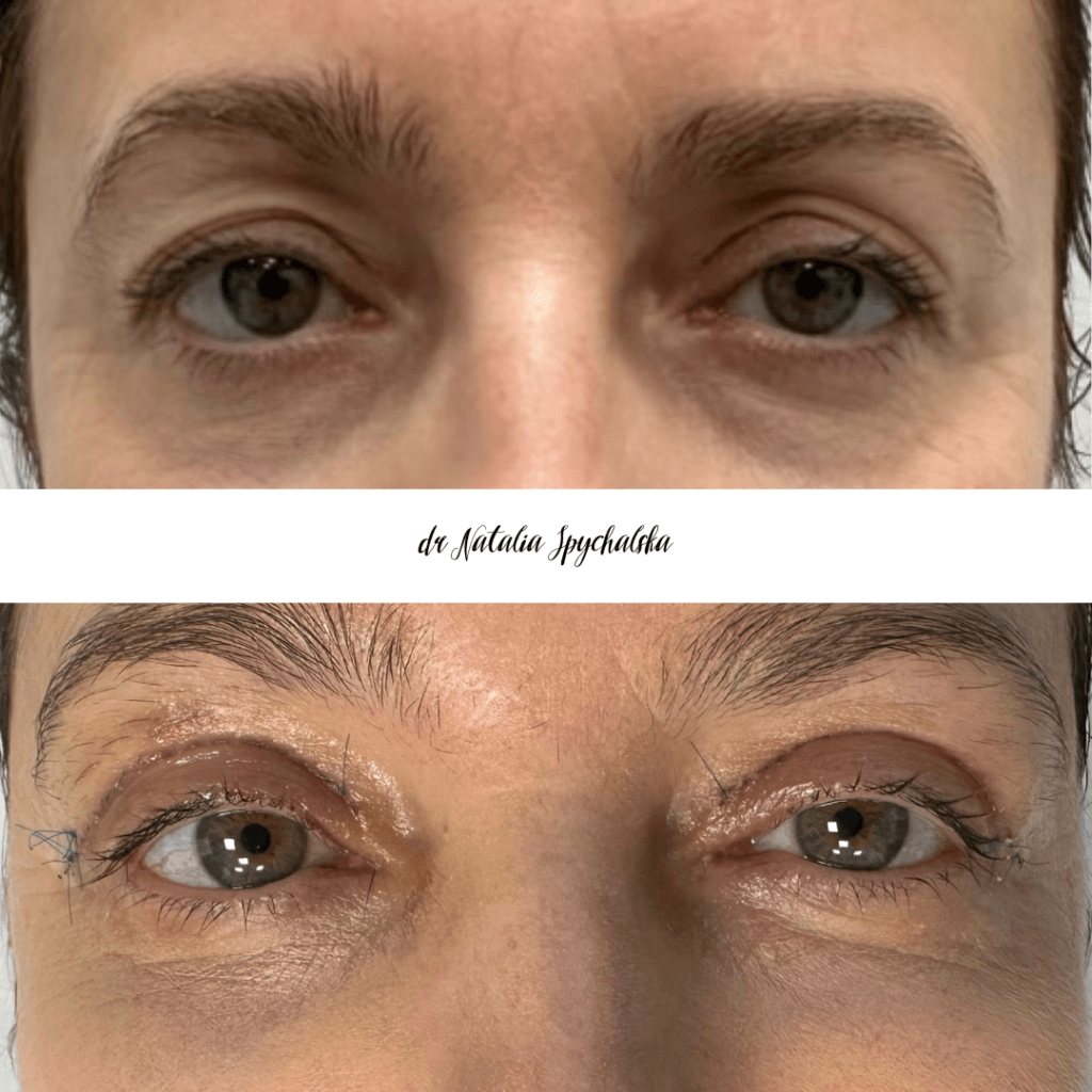 blefaroplastyka – 7
