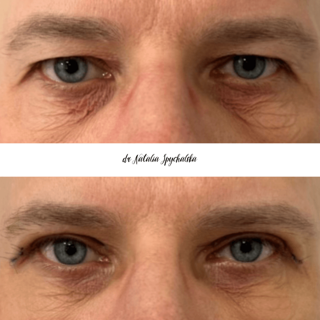 blefaroplastyka – 6