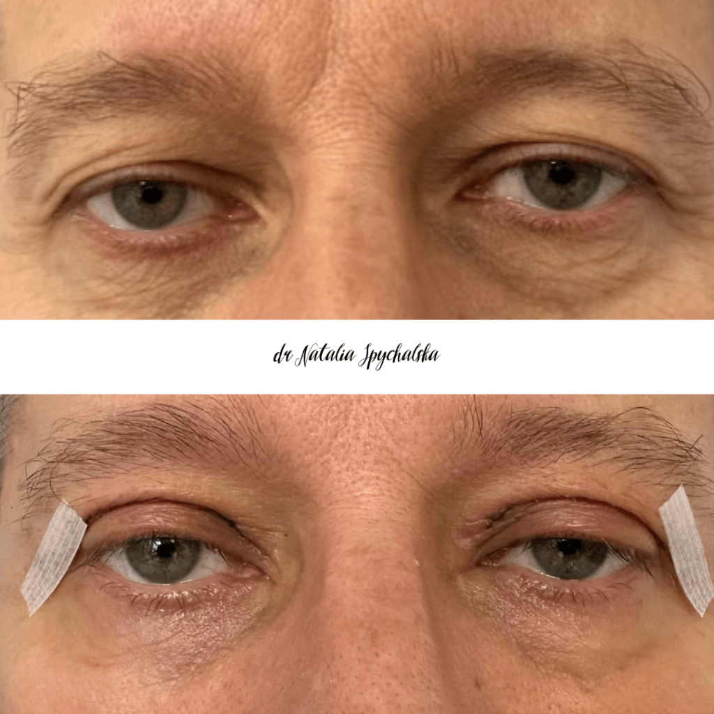 blefaroplastyka – 5