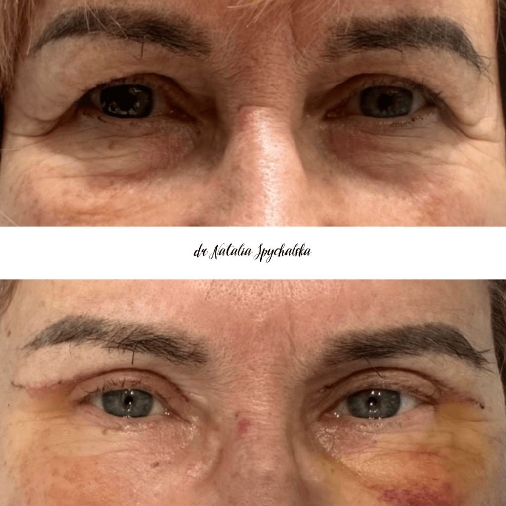 blefaroplastyka – 4