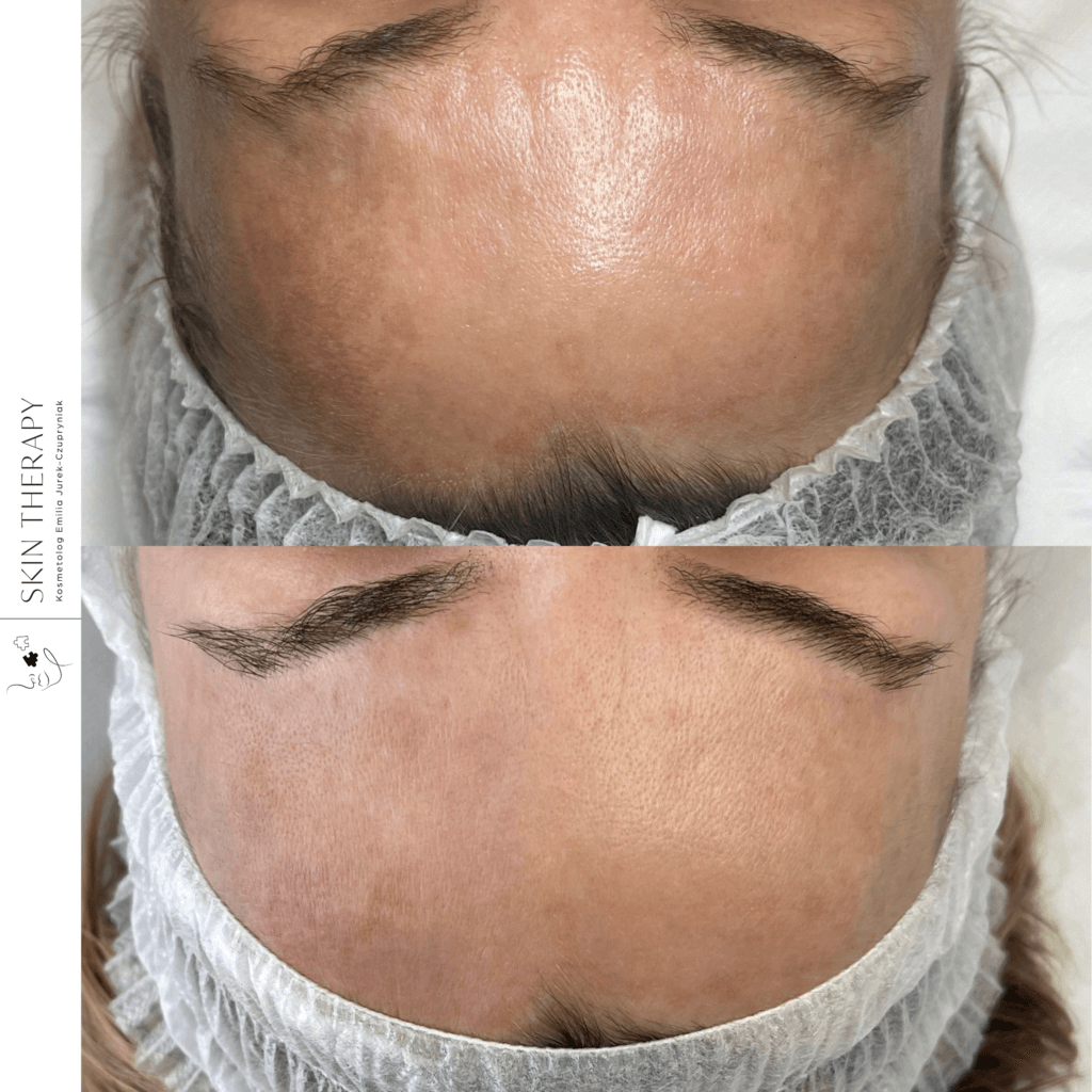 terapie skóry – 11