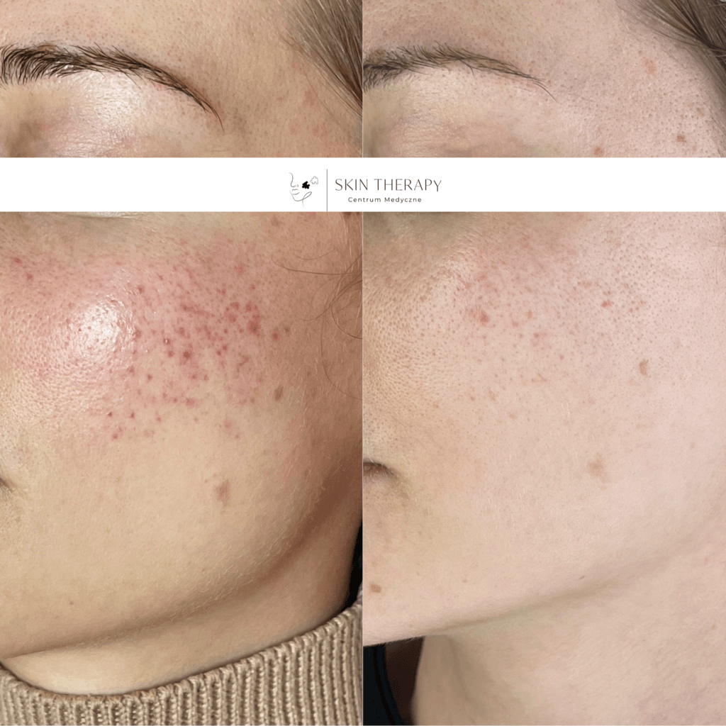terapie skóry – 10