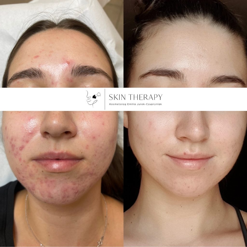 terapie skóry – 63