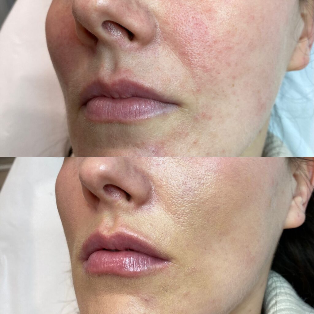 powiększanie ust – 8