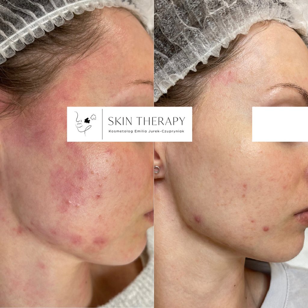 terapie skóry – 61