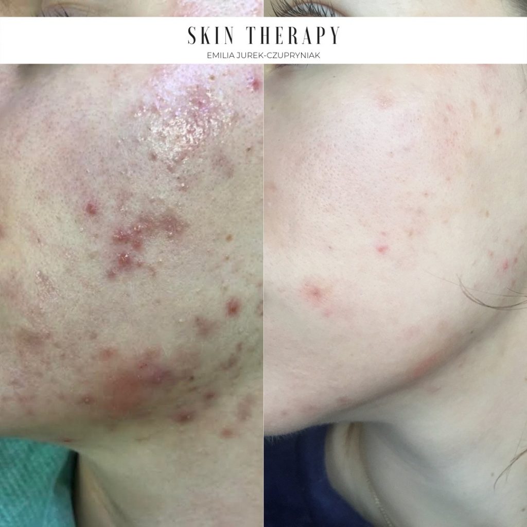 terapie skóry – 62