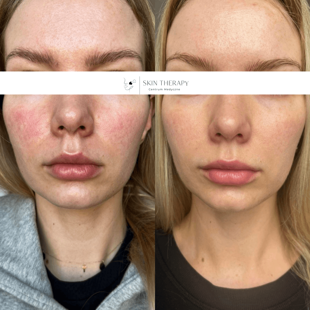 terapie skóry – 9