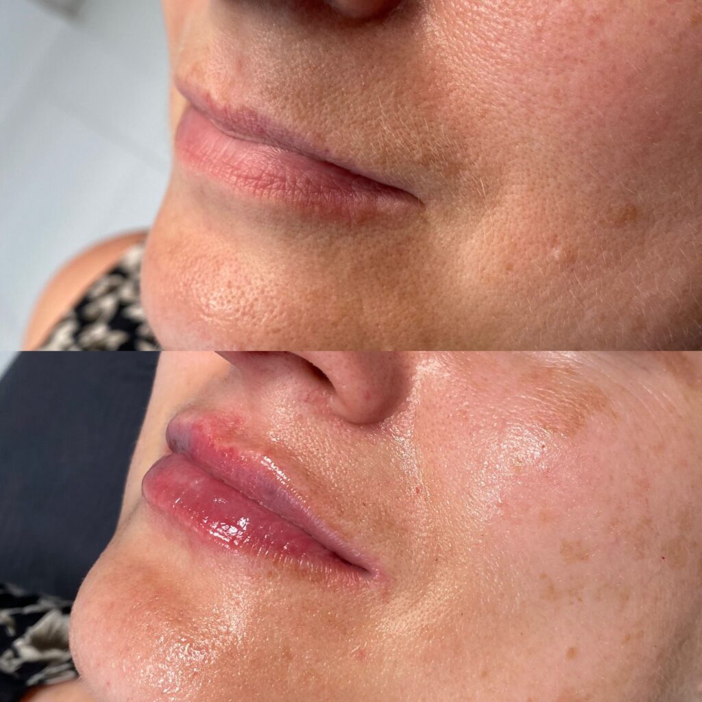 powiększanie ust – 2