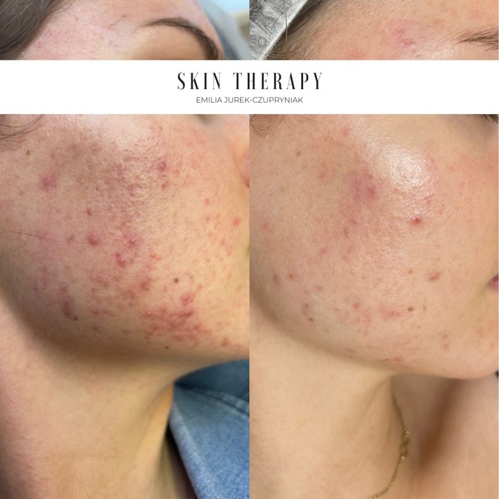 terapie skóry – 52