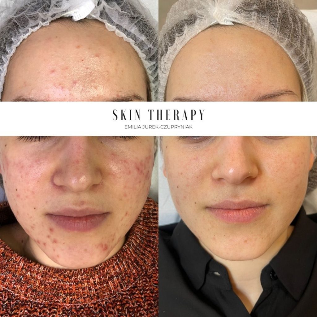 terapie skóry – 51
