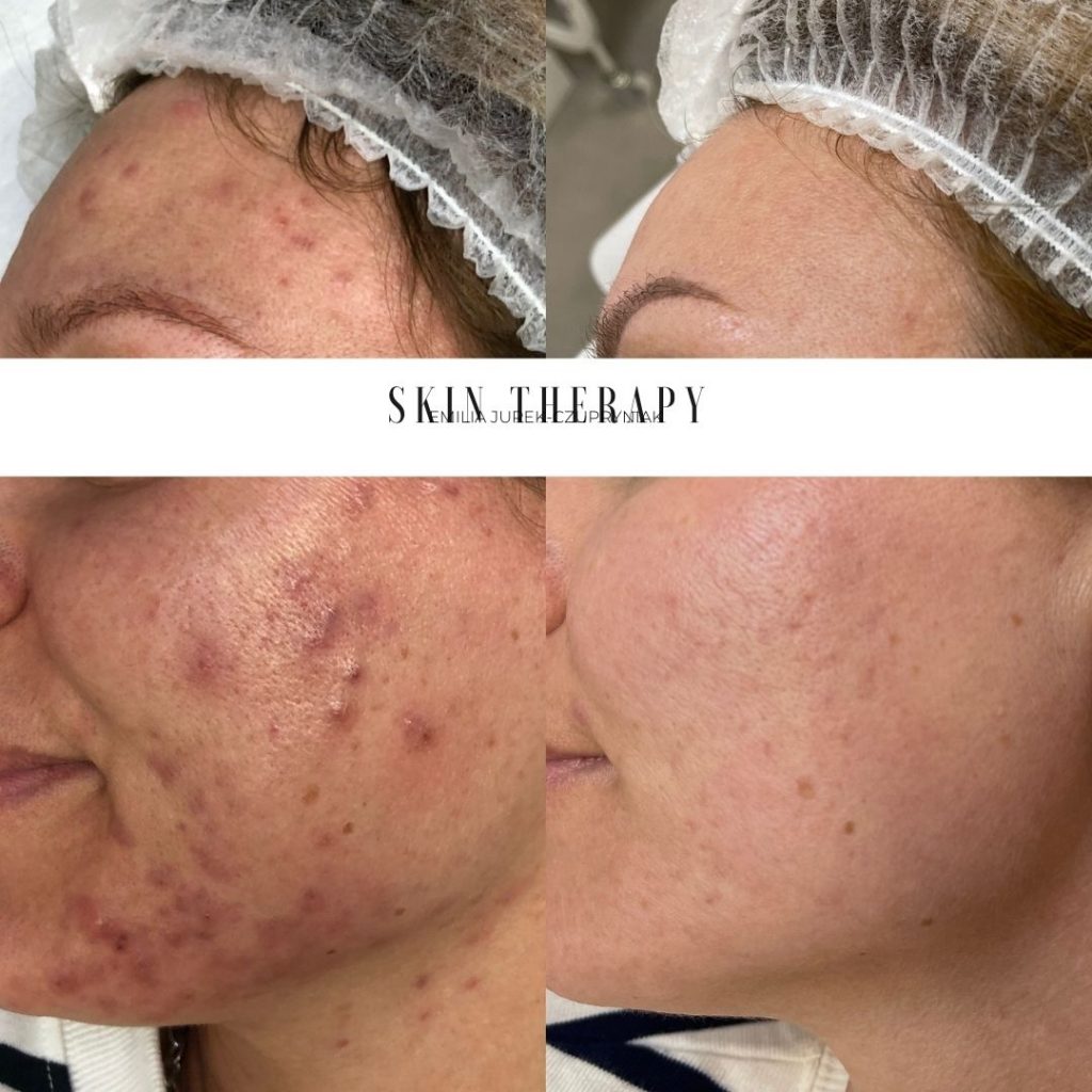 terapie skóry – 50