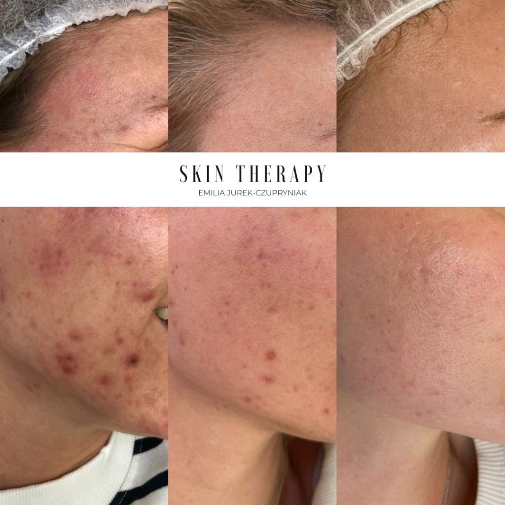 terapie skóry – 49