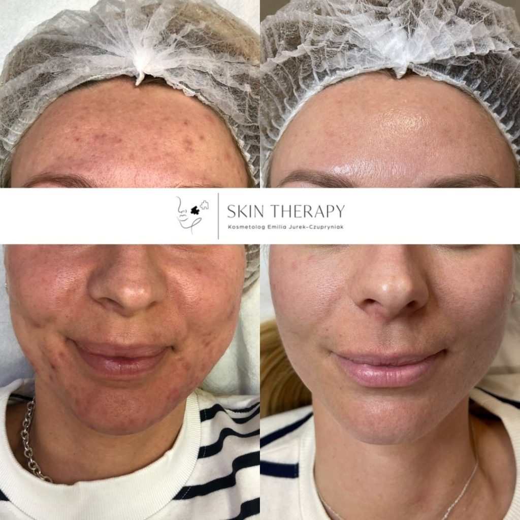 terapie skóry – 48